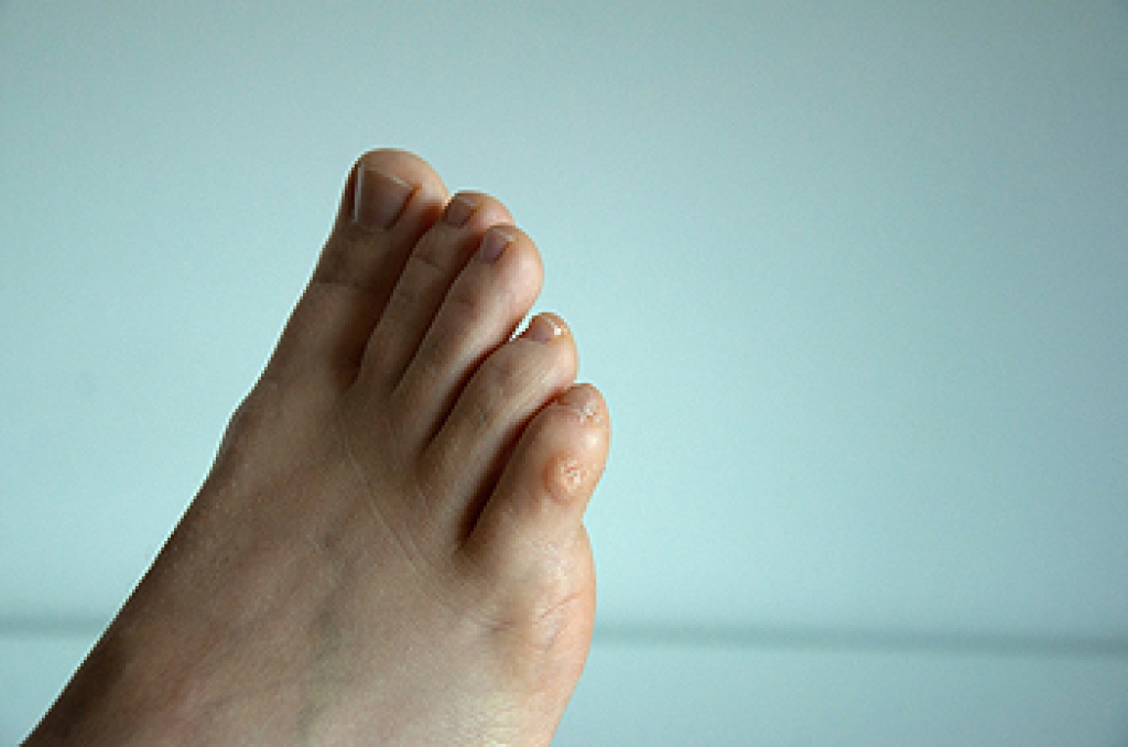 Causes and Treatment of Corns on the Feet